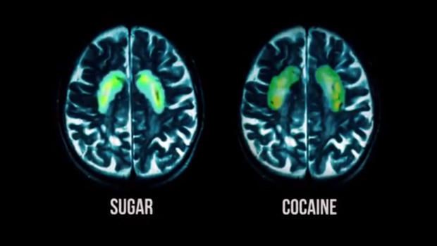 fed-up-sugar-cocaine-brain-scan-620.jpg